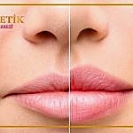 Dudak Kontürü Nedir Nasıl Yapılır?